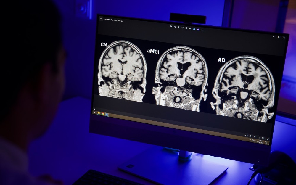 Un paso clave en el avance hacia tratamientos que actúan sobre los mecanismos biológicos de la enfermedad radiografía de un cerebro