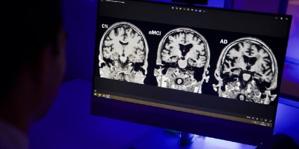 radiografía de un cerebro